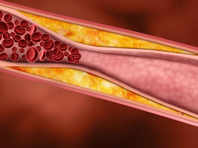 Повышенный уровень холестерина повышает риск развития рака молочной железы