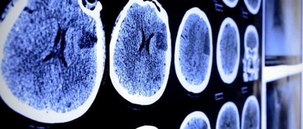 Смертельная форма рака головного мозга имеет потенциал для новой терапии