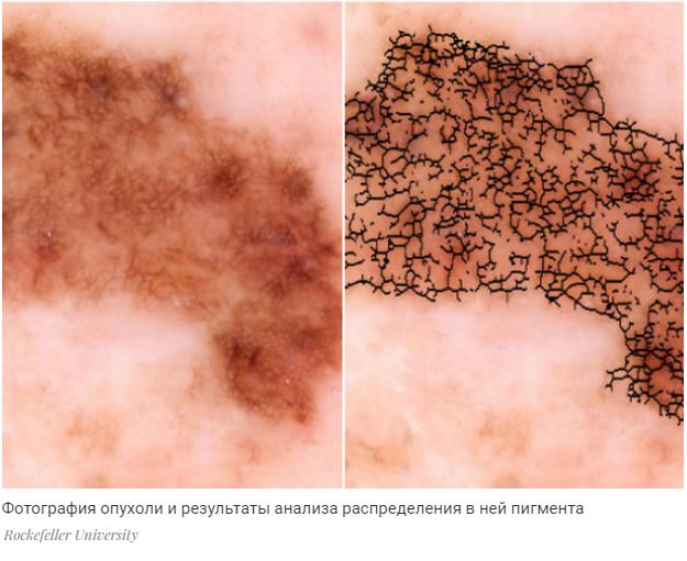Машинное обучение помогло в ранней диагностике меланомы