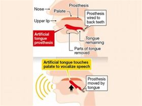 В Японии разрабатывают протез языка